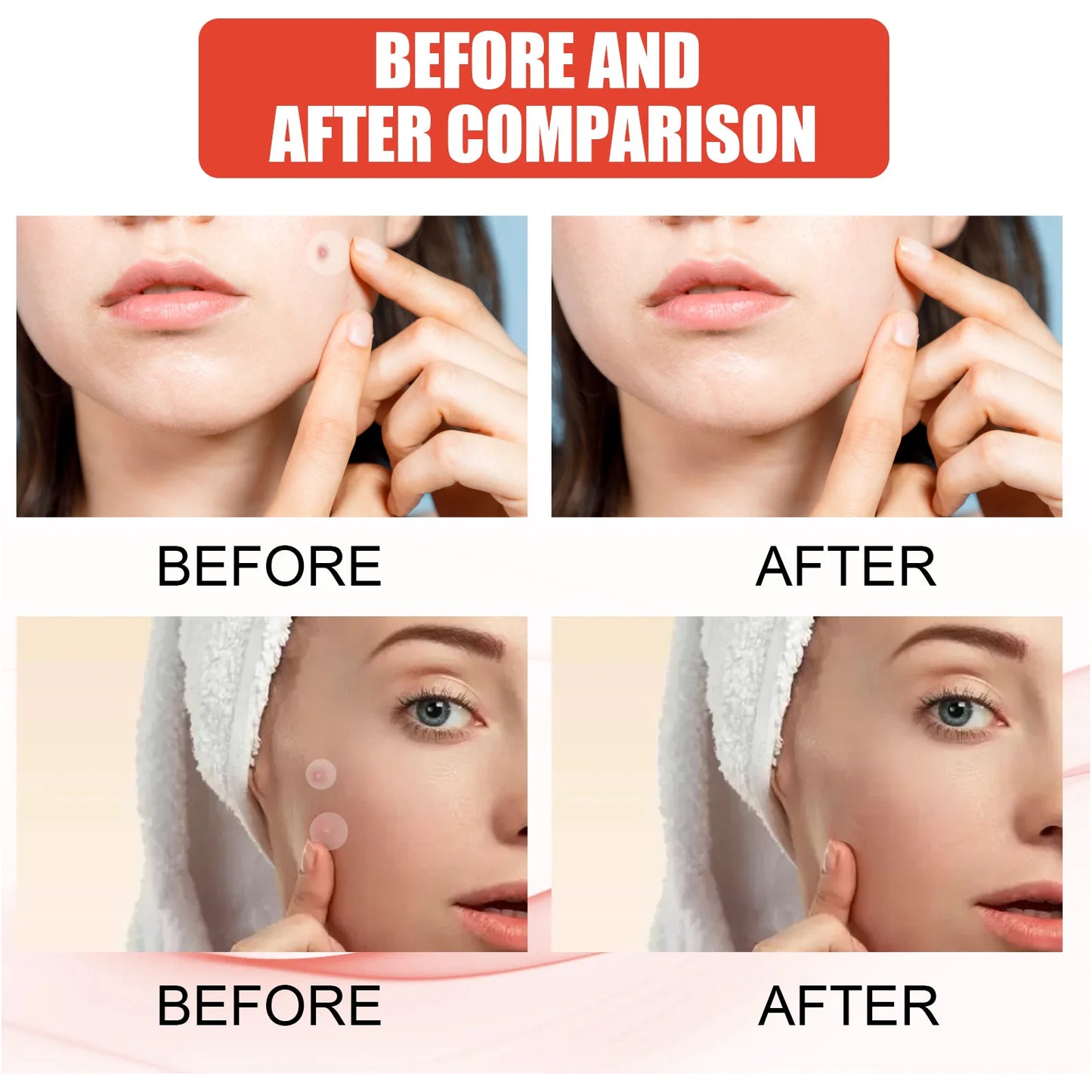 Invisible Face Acne Patches